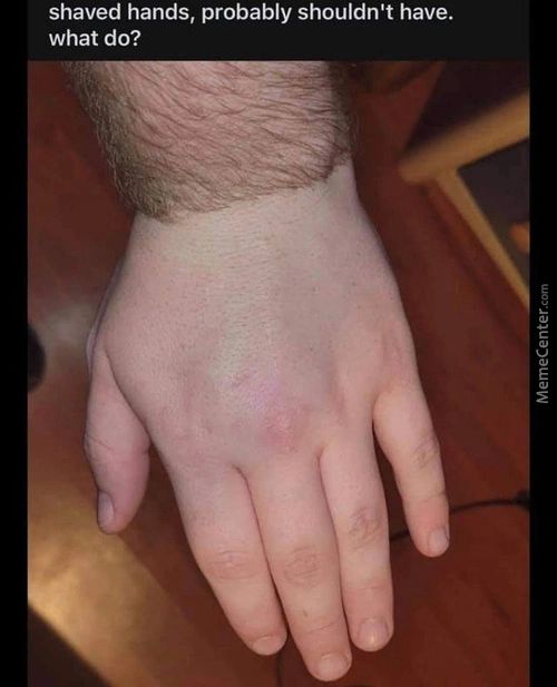 Shaved Hands, Probably Shouldn't Have.
What Do?
